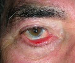 ECTROPION
